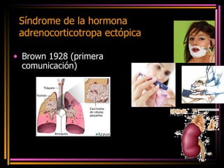 Síndrome de la hormona adrenocorticotropa ectópica Brown 1928 (primera comunicación) 