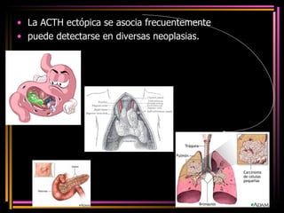 La ACTH ectópica se asocia frecuentemente puede detectarse en diversas neoplasias.  