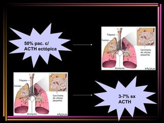 50% pac. c / ACTH ectópica 3-7% sx ACTH 