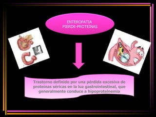 Trastorno definido por una pérdida excesiva de proteínas séricas en la luz gastrointestinal, que generalmente conduce a hipoproteinemia ENTEROPATIA  PIERDE-PROTEINAS 