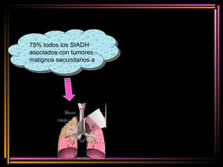 75% todos los SIADH asociados con tumores malignos secundarios a 