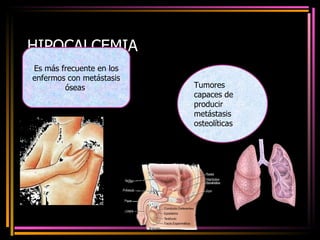 HIPOCALCEMIA Es más frecuente en los enfermos con metástasis óseas . Tumores capaces de producir metástasis osteolíticas 