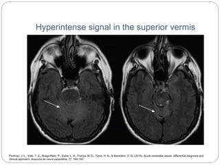 Hyperintense signal in the superior vermis
Pedroso, J. L., Vale, T. C., Braga-Neto, P., Dutra, L. A., França, M. C., Teive, H. A., & Barsottini, O. G. (2019). Acute cerebellar ataxia: differential diagnosis and
clinical approach. Arquivos de neuro-psiquiatria, 77, 184-193.
 