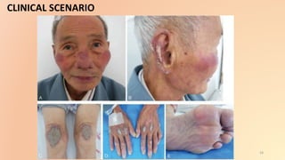 Paraneoplastic Leg Rash Paraneoplastic dermatoses | PPTX