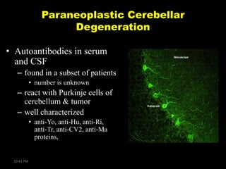 Paraneoplastic Cerebellar
Degeneration
• Autoantibodies in serum
and CSF
– found in a subset of patients
• number is unknown

– react with Purkinje cells of
cerebellum & tumor
– well characterized
• anti-Yo, anti-Hu, anti-Ri,
anti-Tr, anti-CV2, anti-Ma
proteins,

10:41 PM

 