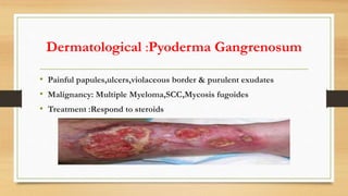 Dermatological :Pyoderma Gangrenosum
• Painful papules,ulcers,violaceous border & purulent exudates
• Malignancy: Multiple Myeloma,SCC,Mycosis fugoides
• Treatment :Respond to steroids
 