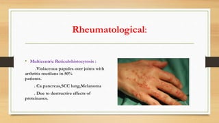 Rheumatological:
• Multicentric Reticulohistocytosis :
.Violaceous papules over joints with
arthritis mutilans in 50%
patients.
. Ca.pancreas,SCC lung,Melanoma
. Due to destructive effects of
proteinases.
 