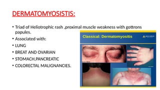 Paraneoplastic Leg Rash PARANEOPLASTIC SYNDROME presentation with case | PPTX
