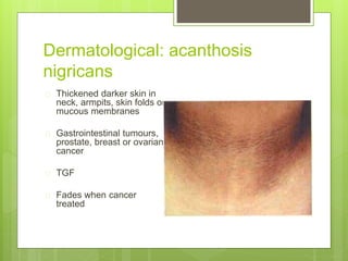 Dermatological: acanthosis
nigricans
 Thickened darker skin in
neck, armpits, skin folds or
mucous membranes
 Gastrointestinal tumours,
prostate, breast or ovarian
cancer
 TGF
 Fades when cancer
treated
 