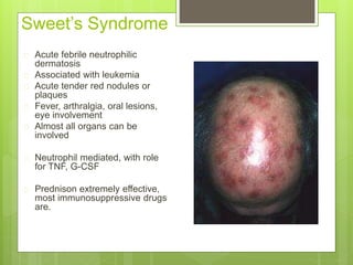 Sweet’s Syndrome
 Acute febrile neutrophilic
dermatosis
 Associated with leukemia
 Acute tender red nodules or
plaques
 Fever, arthralgia, oral lesions,
eye involvement
 Almost all organs can be
involved
 Neutrophil mediated, with role
for TNF, G-CSF
 Prednison extremely effective,
most immunosuppressive drugs
are.
 