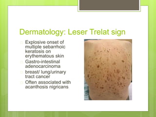 Dermatology: Leser Trelat sign
 Explosive onset of
multiple sebarrhoic
keratosis on
erythematous skin
 Gastro-intestinal...