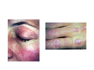 Paraneoplastic Leg Rash Paraneoplastic syndromes - CNS manifestations | PPTX