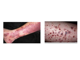 Paraneoplastic Leg Rash Paraneoplastic syndromes - CNS manifestations | PPTX