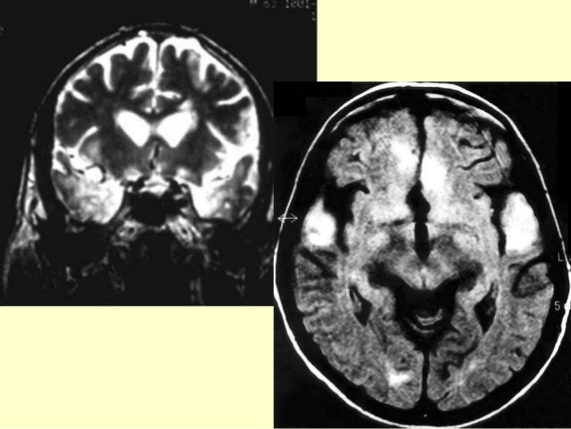 Paraneoplastic syndromes2013