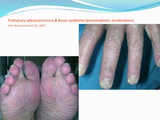 Paraneoplastic syndromes presentation | PPTX