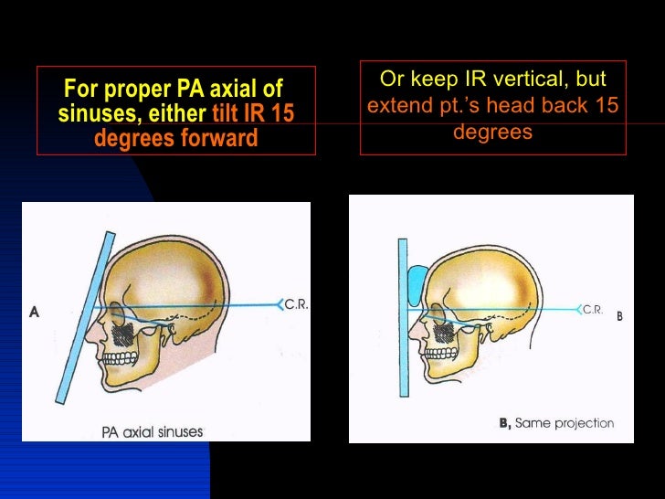Paransasal Sinuses Home Edition Paransasal Sinuses Home Edition