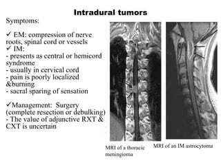 Intradural tumors
MRI of a thoracic
meningioma
MRI of an IM astrocytoma
Symptoms:
 EM: compression of nerve
roots, spinal cord or vessels
 IM:
- presents as central or hemicord
syndrome
- usually in cervical cord
- pain is poorly localized
&burning
- sacral sparing of sensation
Management: Surgery
(complete resection or debulking)
- The value of adjunctive RXT &
CXT is uncertain
 