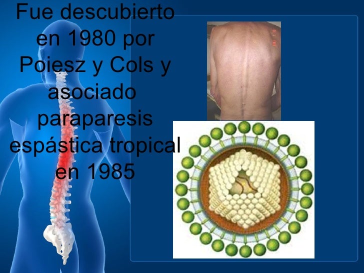 PARAPARESIA ESPASTICA PDF PARAPARESIA ESPASTICA PDF