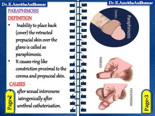 PARAPHIMOSIS
DEFINITION
• Inability to place back
(cover) the retracted
prepucial skin over the
glans is called as
paraphimosis.
• It causes ring like
constriction proximal to the
corona and prepuceal skin.
CAUSES
• after sexual intercourse
• iatrogenically after
urethral catheterisation.
 