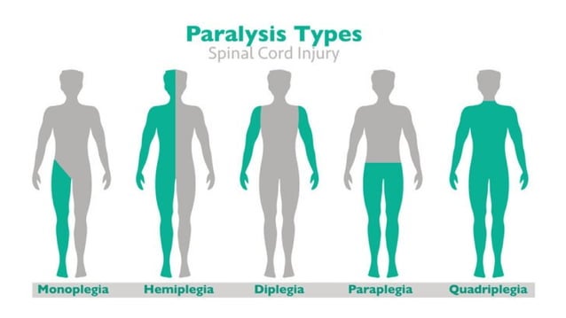 Paraplegia(Type of paralysis) Unit-VI.pptx