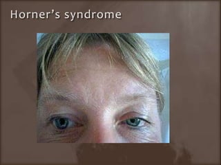 Horner’s syndrome 