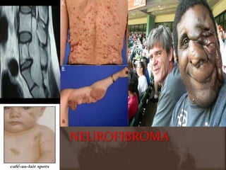 NEUROFIBROMA
