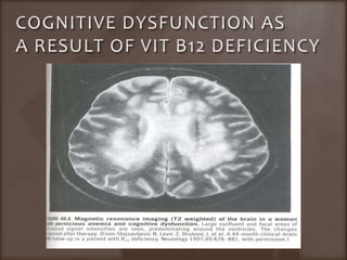 COGNITIVE DYSFUNCTION AS A RESULT OF VIT B12 DEFICIENCY