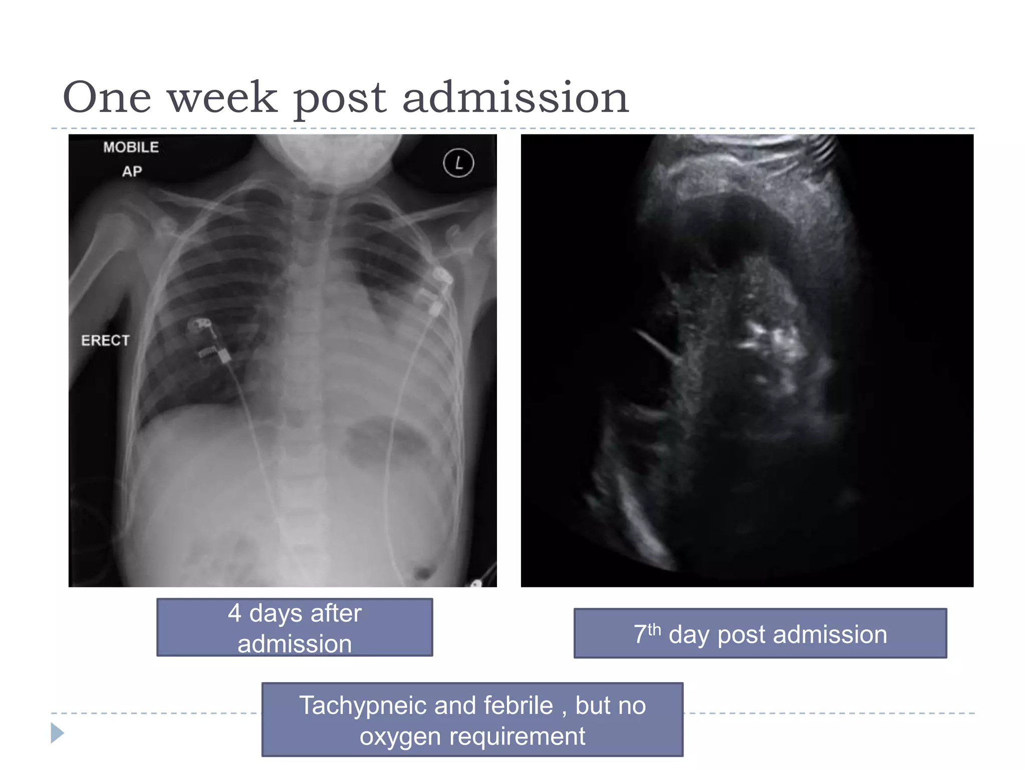 One week post admission
4 days after
admission 7th day post admission
Tachypneic and febrile , but no
oxygen requirement
 