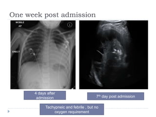 One week post admission
4 days after
admission 7th day post admission
Tachypneic and febrile , but no
oxygen requirement
 
