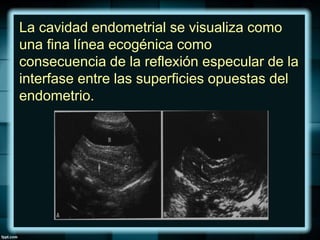 La cavidad endometrial se visualiza como
una fina línea ecogénica como
consecuencia de la reflexión especular de la
interfase entre las superficies opuestas del
endometrio.
 