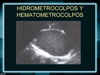HIDROMETROCOLPOS Y
HEMATOMETROCOLPOS
 