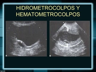 HIDROMETROCOLPOS Y
HEMATOMETROCOLPOS
 