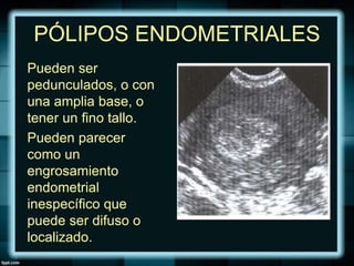 PÓLIPOS ENDOMETRIALES
Pueden ser
pedunculados, o con
una amplia base, o
tener un fino tallo.
Pueden parecer
como un
engrosamiento
endometrial
inespecífico que
puede ser difuso o
localizado.
 