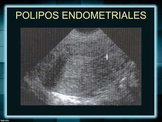 POLIPOS ENDOMETRIALES
 