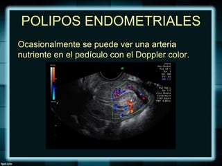 POLIPOS ENDOMETRIALES
Ocasionalmente se puede ver una arteria
nutriente en el pedículo con el Doppler color.
 