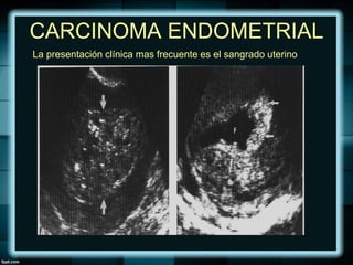 CARCINOMA ENDOMETRIAL
La presentación clínica mas frecuente es el sangrado uterino
 