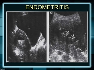 ENDOMETRITIS
 