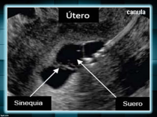 Endometrio, Ecografía y Patología