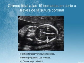Cráneo fetal a las 19 semanas en corte a
través de la sutura coronal
(Flechas largas) Ventrículos laterales.
(Flechas pequeñas) Los fórnices.
(c) Cavum septi pellucidi.
 
