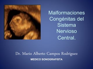 Malformaciones
Congénitas del
Sistema
Nervioso
Central.
Dr. Mario Alberto Campos Rodríguez
MEDICO SONOGRAFISTA
 
