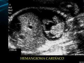 HEMANGIOMA CARDÍACO
 