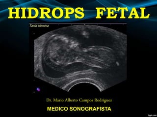 HIDROPS FETAL
Dr. Mario Alberto Campos Rodríguez
MEDICO SONOGRAFISTA
 