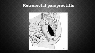 Retrorectal paraproctitis
 