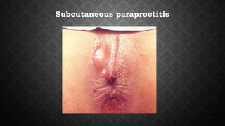 Subcutaneous paraproctitis
 