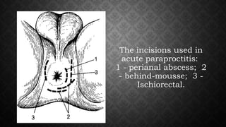 The incisions used in
acute paraproctitis:
1 - perianal abscess; 2
- behind-mousse; 3 -
Ischiorectal.
 