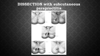 DISSECTION with subcutaneous
paraproctitis
 