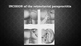 INCISION of the retrectectal paraproctitis
 