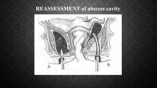 REASSESSMENT of abscess cavity
 