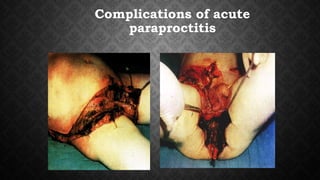 Complications of acute
paraproctitis
 
