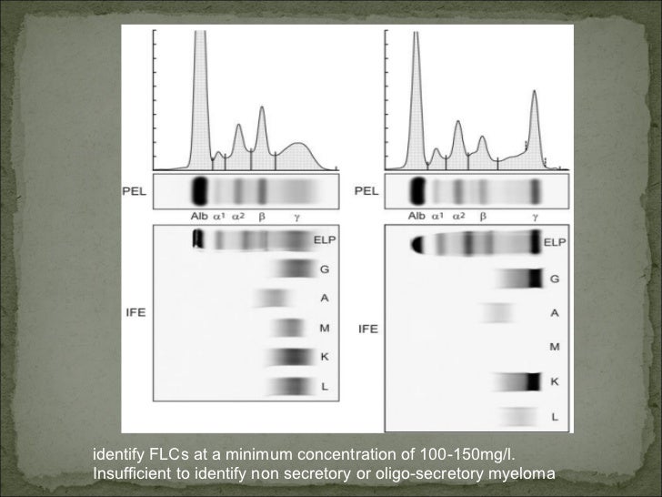 Paraproteins and the Kidney
